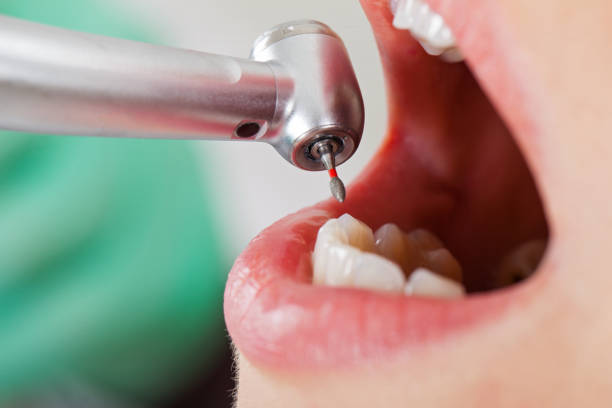 Best Emergency Wisdom Teeth Removal in Bluffton, SC